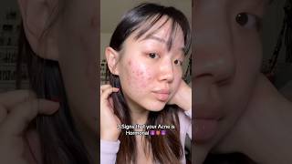 How I knew my acne was Hormonal 🥲 #acne #hormonalacne #acnejourney #viral