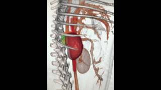 副腎腫瘍CT-3D動画③  松波動物病院