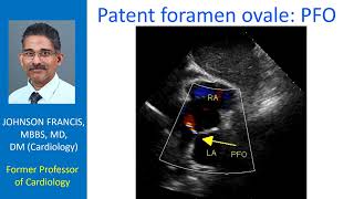 Patent foramen ovale (PFO)