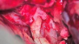 orbitozygomatic craniotomy for suprasellar tumor