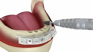 Full Arch Rehabilitation Using Anatomic Guide® Protocol