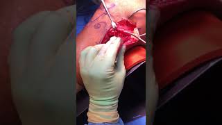 Lateral Approach to the Knee - Surgical dissection for LCL repair