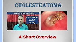 Cholesteatoma - a Short Overview