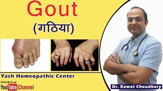 Gout (गठिया) का सबसे अच्छा इलाज | Best treatment of Gout | What is Gout? | Why Gout Happens?