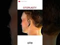 ear reshaping surgery 👂 otoplasty