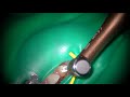 Root canal preparation to MTA obturation with an Ai motor T-mode