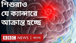 মস্তিষ্কের ক্যান্সার: শিশুরাও যে ক্যান্সারে আক্রান্ত হচ্ছে তার কারণ, লক্ষণ ও চিকিৎসা কী?