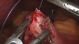 LAPAROSCOPIC PYLOROPLASTY