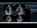 IQ 240 AFI LA  HWD ECHOCARDIOGRAPHY GME  ECHOPAC ANALYSIS