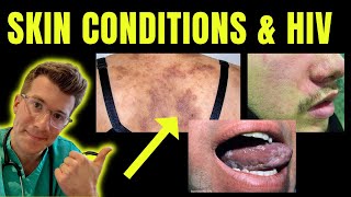 Doctor explains skin conditions associated with HIV / AIDS (e.g. Kaposi sarcoma, candida & more)