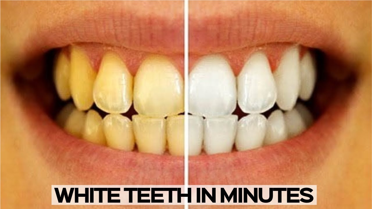 HOW TO WHITEN YOUR TEETH - EASY AND QUICK TEETH WHITENING 2023 - YouTube