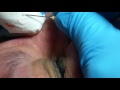 extracting milia on the nose