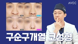 '구순열 코성형' ㅣ어떻게?! 실제 수술 사례.JPG