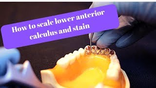 How to scale mandibular anterior calculus and stain