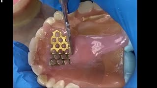 Denture Repair with Gold Mesh