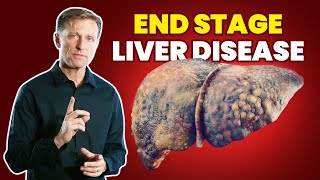 10 Signs of a Dying Liver  (End Stage Liver Disease)