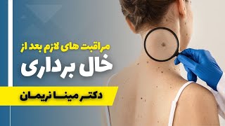 مراقبت های بعد از خال برداری / انجامش خیلی مهمه تا محل خال بعد از ریمو باقی نماند