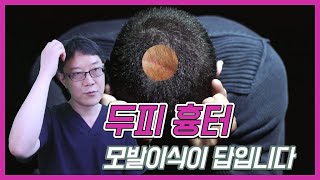 두피 흉터 모발이식이 답이다. 흉터모발이식 2번을 추천하는 이유