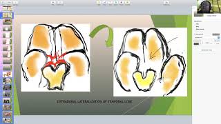 ACNS SYMPOSIUM #1: Iype Cherian: Skull Base Basics