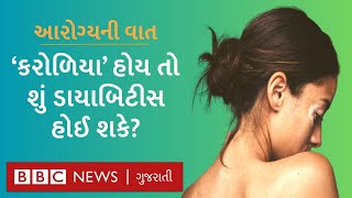 ચામડી પર થતાં કરોળિયા શું છે? કેટલી ગંભીર હોઈ શકે છે આ બીમારી? Skin Care