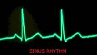 audible heart beat - extrasystoles / PVC and sinus beats