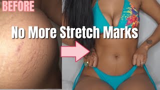 How I Got Rid Of My Stretch Marks FOR GOOD! Works for Existing Stretch Marks.