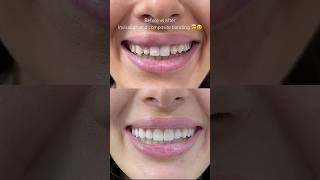 Invisalign and composite bonding by Dr. Sonnie 🙌 #compositebonding