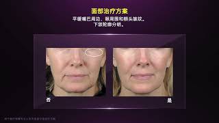 在 Waleerat Clinic 的Thermage FLX 第五代热玛吉