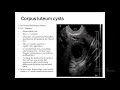 functional ovarian cyst video