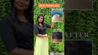 HT Before and After #hair #hairtreatment #beforeandafter #chennai #hairloss #haircare