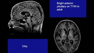 Quarantine University- Imaging of Pituitary Gland and supraselllar region