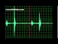 Small Muscular Ventricular Septal Defect- normal speed