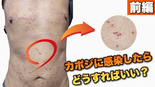 【40代　アトピー】前編　閲覧注意！！カポジ感染が悪化したらこうなります！！ 卒業編