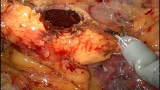 432 Utility of near infrared fluorescence imaging in robotic partial cystectomy-  Karthik Thandapani