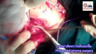 การผ่าตัดทวารเทียมปลิ้น Prolapsed stroma surgery