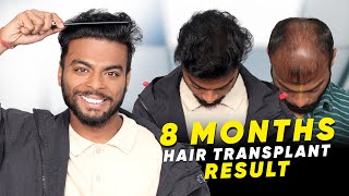 Hair Transplant in Hubli | Best Results \u0026 Cost of Hair Transplant in Hubli