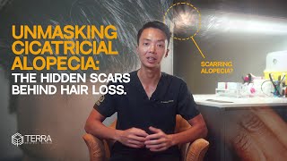 Unmasking Cicatricial Alopecia: The Hidden Scars Behind Hair Loss - Hair Talks by Terra Medical