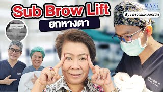 ยกหางตา Sub Brow Lift ตาสวย ไร้แผล