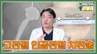 허리 치료하셨는데 효과 없으신 분들 고관절 꼭 확인해 보세요!｜고관절 인공관절 치환술 케이스｜수술 읽어주는 남자👨‍⚕️