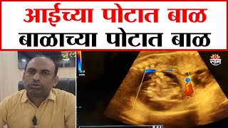 आईच्या पोटात बाळ आणि बाळाच्या पोटातही बाळ:Buldhana  News