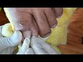 serious curved nail creates so much pressure and relief it nail​​​ asmr fyp ear shorts viral