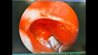 【鼻竇植牙體】內視鏡移除手術示範－張耕閤醫師