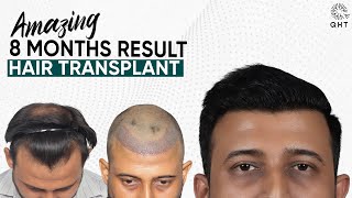 Hair Transplant in Chennai | Best Results \u0026 Cost of Hair Transplant in Chennai