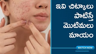 ఇవి చిట్కాలు పాటిస్తే మొటిమలు మాయం | pimples prevention | Health Tips | ur choice telugu