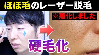 【硬毛化】ほほ毛のレーザー脱毛受けたら逆に悪化した件について【脱毛失敗】