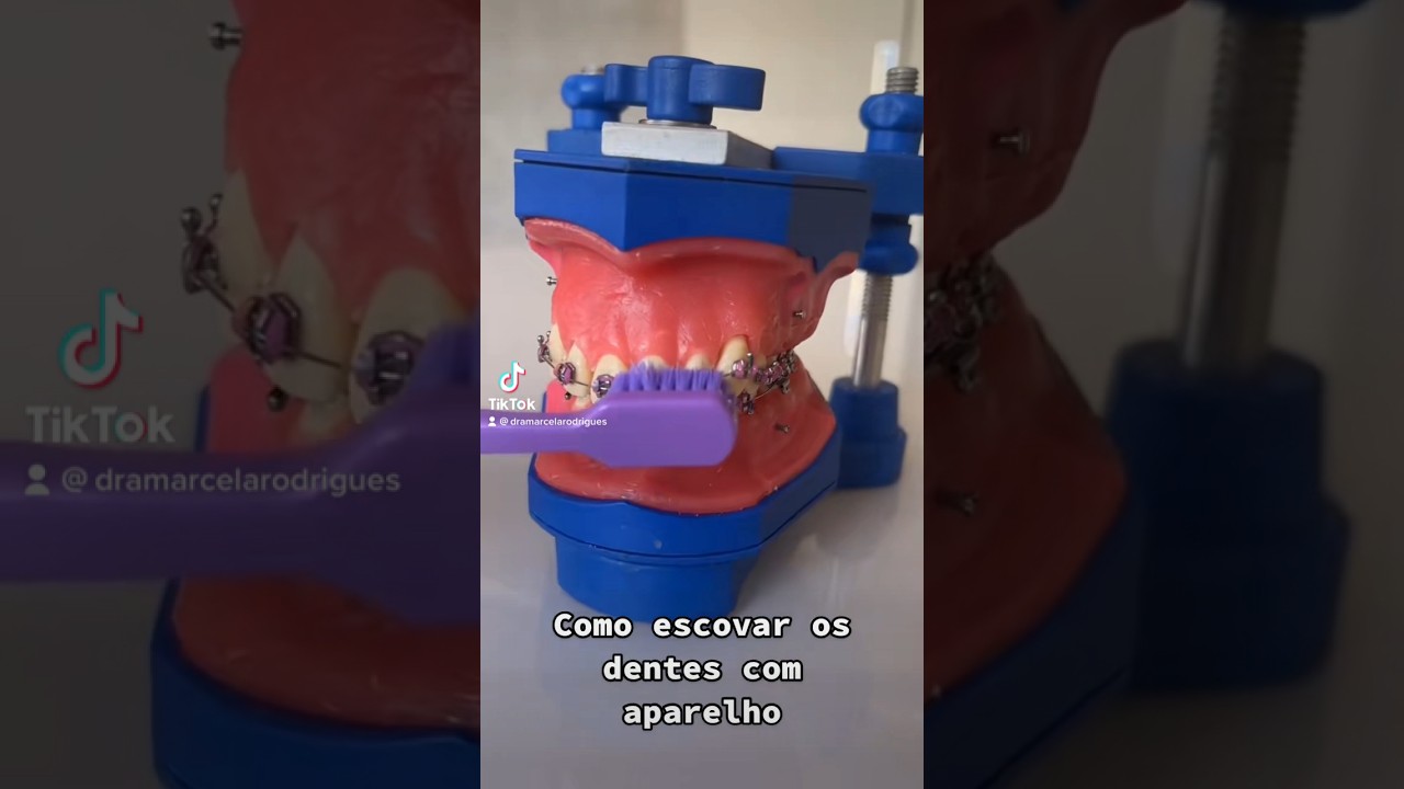 Como Escovar Os Dentes Com Aparelho - YouTube