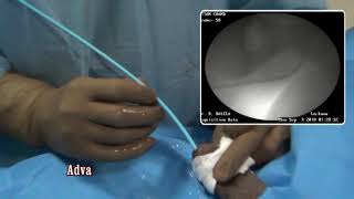 Sequential dilatation of stricture  How to do