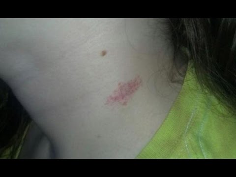 How to Get Rid of A Hickey Fast and Naturally How to Get Rid of A Hickey Fast and Naturally