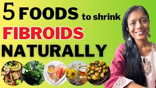 Fibroids Diet: 5 Foods to Shrink Fibroids Naturally