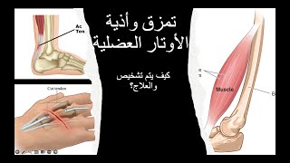 Tendons Injury /أذية الأوتار العضلية